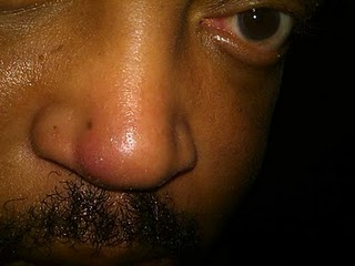 Ed's stuffy nose